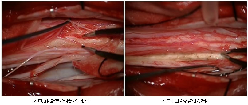 我院神经外科疼痛外科专业组开展脊髓背根入髓区切开术治疗癌性神经病理性疼痛