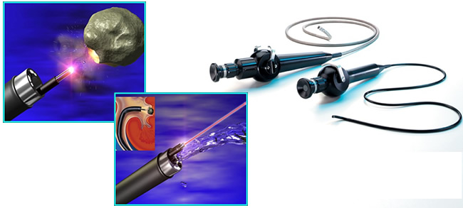 泌尿外科成功开展电子输尿管软镜碎石取石术