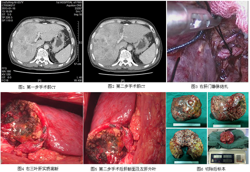 肝胆胰外科一区成功实施我院首例联合肝脏离断和门静脉结扎二步肝切除术