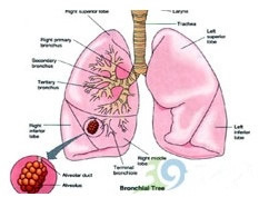 您了解肺部小结节性病变吗