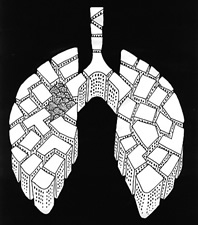 您了解肺部小结节性病变吗