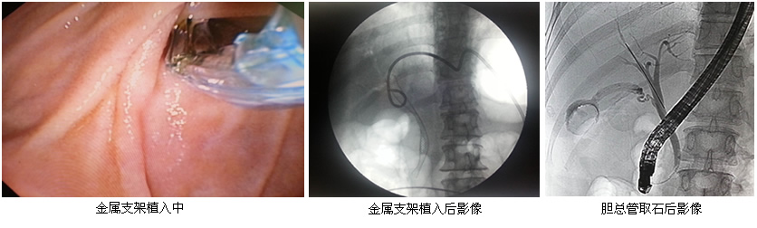 肝胆胰外科成功开展ERCP相关技术