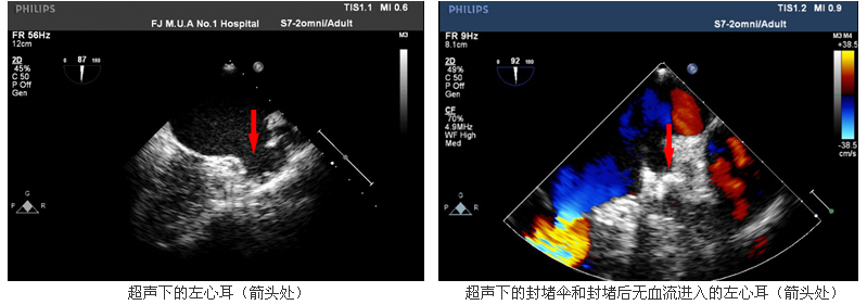 我院心血管内科一天成功完成3例房颤患者经皮左心耳封堵术