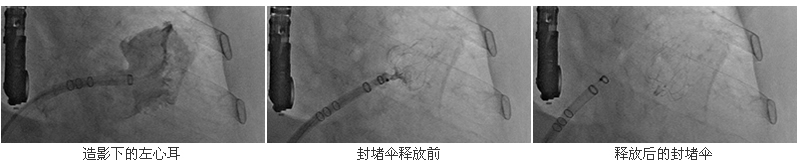 我院心血管内科一天成功完成3例房颤患者经皮左心耳封堵术