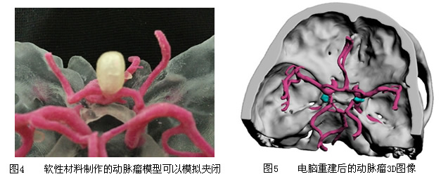 我院神经外科开创我国先例——应用3D打印颅内动脉瘤模型指导脑动脉瘤外科手术