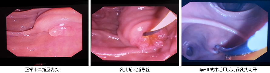 安全至上  用科研的态度对待每一例患者--肝胆胰外科ERCP开展突破50例