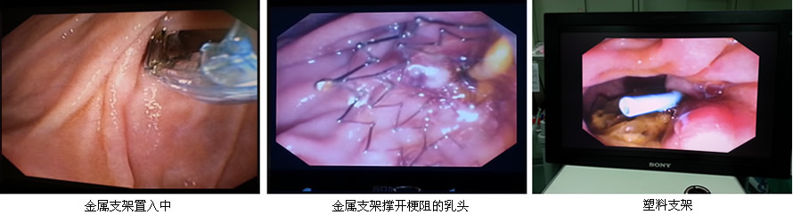 安全至上  用科研的态度对待每一例患者--肝胆胰外科ERCP开展突破50例