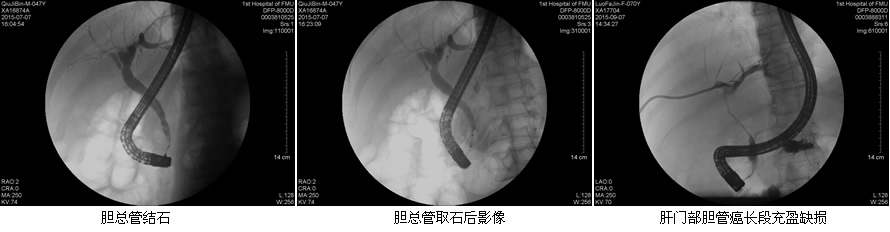 安全至上  用科研的态度对待每一例患者--肝胆胰外科ERCP开展突破50例
