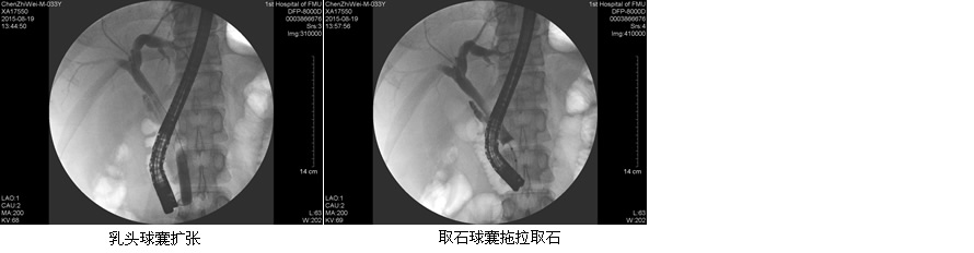 安全至上  用科研的态度对待每一例患者--肝胆胰外科ERCP开展突破50例