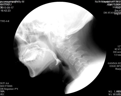 康复科成功开展吞咽造影录像检查与评估相关技术