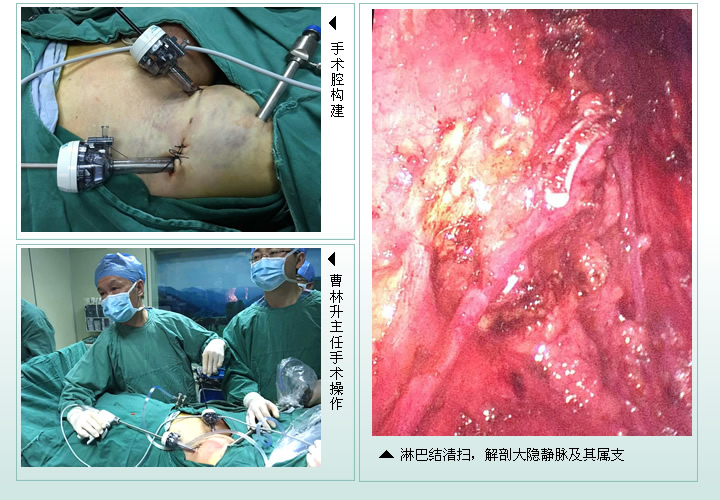 泌尿外科二区成功开展我院首例腹腔镜下阴茎癌双侧腹股沟淋巴结清扫术