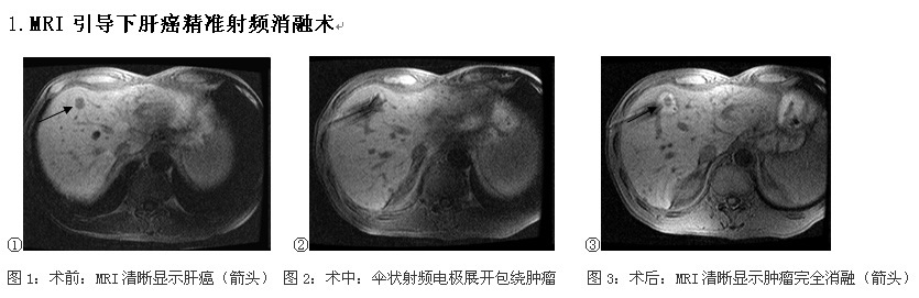 前进中的福建医科大学附属第一医院介入科
