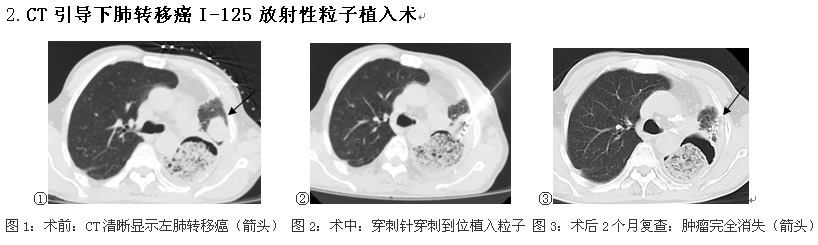 前进中的福建医科大学附属第一医院介入科