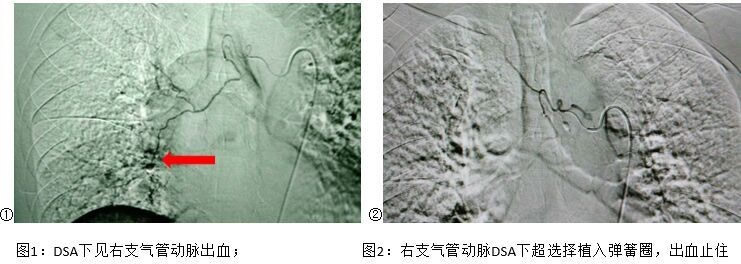 前进中的福建医科大学附属第一医院介入科