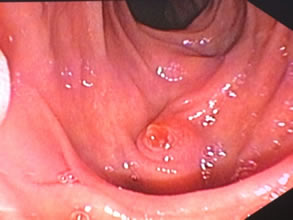 我院肝胆胰外科成功开展多例胃毕-Ⅱ式术后ERCP
