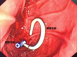 我院肝胆胰外科成功开展多例胃毕-Ⅱ式术后ERCP