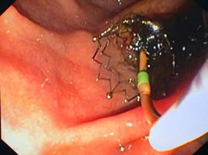 我院肝胆胰外科成功开展多例胃毕-Ⅱ式术后ERCP