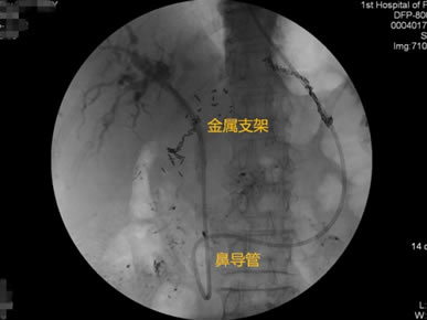 我院肝胆胰外科成功开展多例胃毕-Ⅱ式术后ERCP