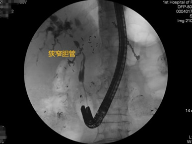 我院肝胆胰外科成功开展多例胃毕-Ⅱ式术后ERCP