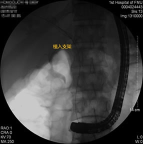 我院肝胆胰外科成功开展多例胃毕-Ⅱ式术后ERCP
