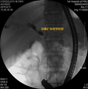 我院肝胆胰外科成功开展多例胃毕-Ⅱ式术后ERCP