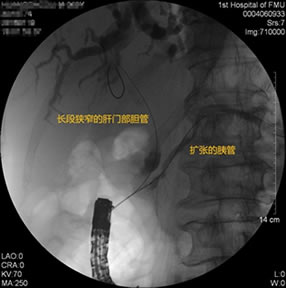 我院肝胆胰外科成功开展多例胃毕-Ⅱ式术后ERCP