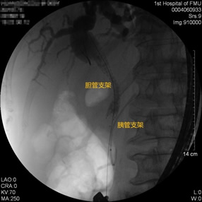 我院肝胆胰外科成功开展多例胃毕-Ⅱ式术后ERCP