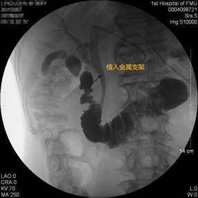 我院肝胆胰外科成功开展多例胃毕-Ⅱ式术后ERCP
