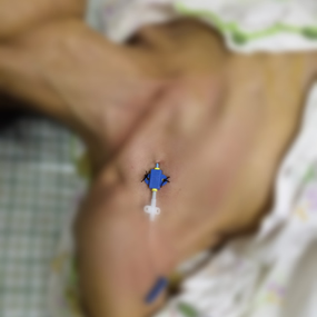 我院急诊科深静脉置管技术的“昨天、今天与明天”