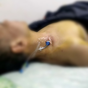 我院急诊科深静脉置管技术的“昨天、今天与明天”