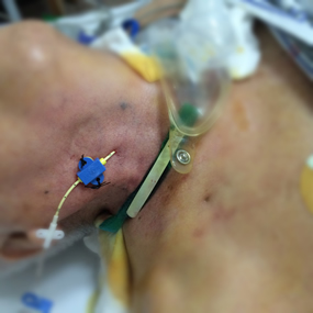 我院急诊科深静脉置管技术的“昨天、今天与明天”