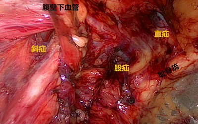 腹腔镜疝修补术优势多：钻3孔补6洞