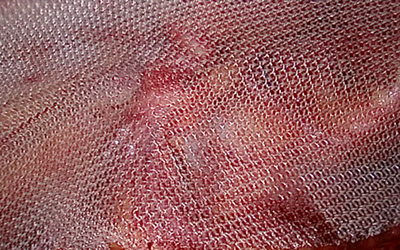 腹腔镜疝修补术优势多：钻3孔补6洞