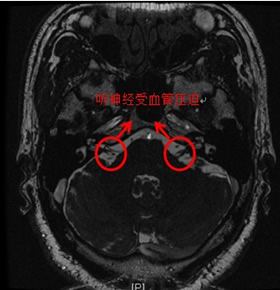 顽固性眩晕也能通过手术治疗？——我院完成省内首例微血管减压手术治疗难治性眩晕