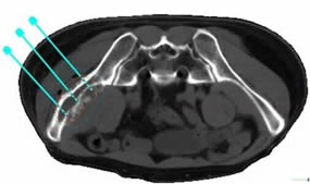 我院介入科成功开展福建首例3D打印模板引导下的放射性粒子植入手术