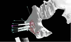 我院介入科成功开展福建首例3D打印模板引导下的放射性粒子植入手术