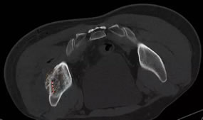 我院介入科成功开展福建首例3D打印模板引导下的放射性粒子植入手术