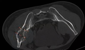 我院介入科成功开展福建首例3D打印模板引导下的放射性粒子植入手术