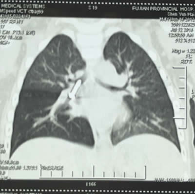 【媒体看附一】－－4岁男娃吞下螺丝钉  卡在气管命悬一线　附一医院专家妙手摘除