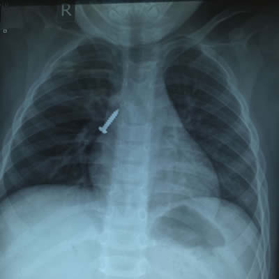 【媒体看附一】－－4岁男娃吞下螺丝钉  卡在气管命悬一线　附一医院专家妙手摘除