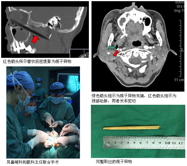 【媒体看附一】－－罕见异物与血管近在咫尺  危难时刻有医生妙手除疴