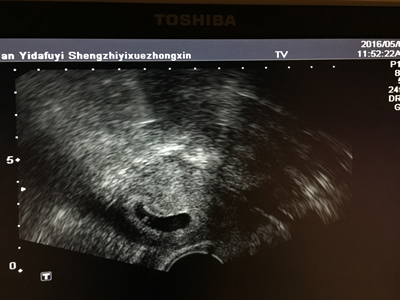 子宫超薄内膜受孕  附一医院生殖医学中心又获突破性进展