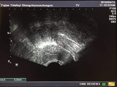 子宫超薄内膜受孕  附一医院生殖医学中心又获突破性进展