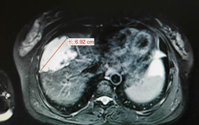 我院介入科开展肝血管瘤的微创介入治疗