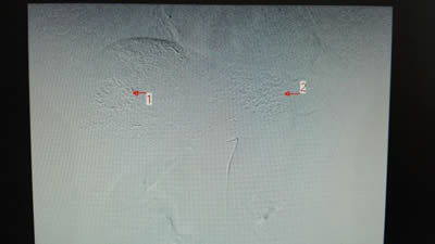 我院介入科开展肝血管瘤的微创介入治疗