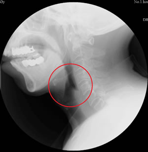 小小导尿管解决大问题——我院康复医学科采用导尿管球囊扩张技术成功为患者解除吞咽障碍