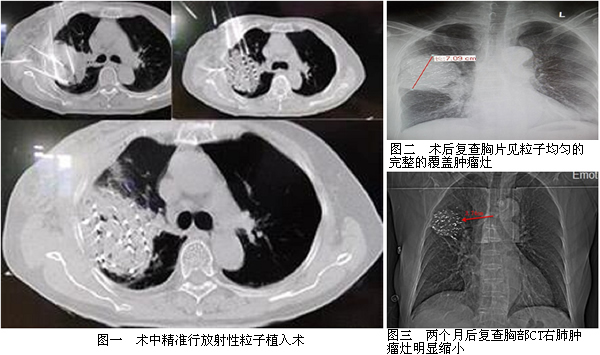 我院介入科成熟应用放射性粒子植入术为肺癌患者带来新曙光
