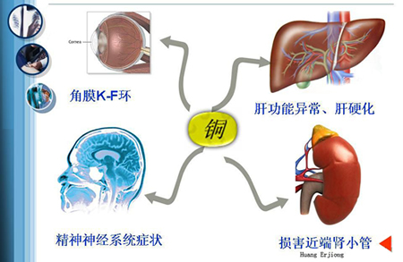 肝豆状核变性护理常规