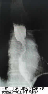 食道支架——解决食管癌患者进食难题