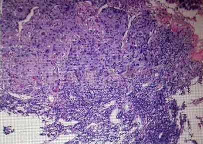 食道支架——解决食管癌患者进食难题